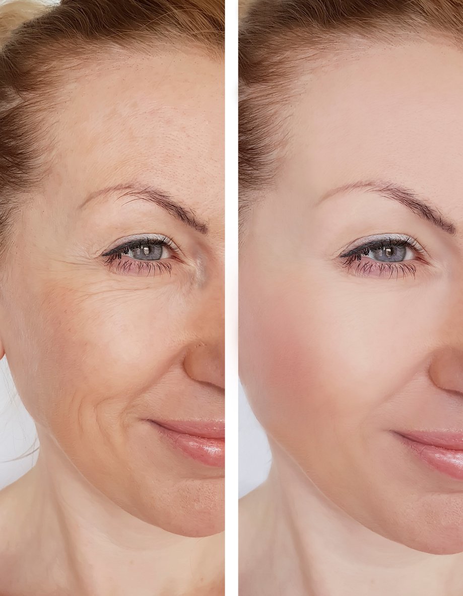 woman wrinkles face before and after cosmetic procedures